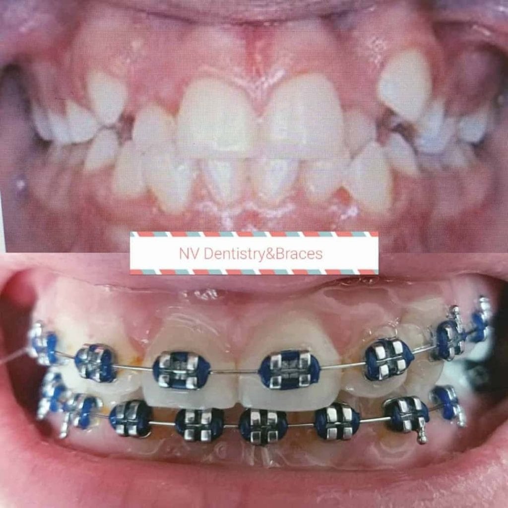 Before & After Gallery Nevada Dentistry & Braces Las Vegas