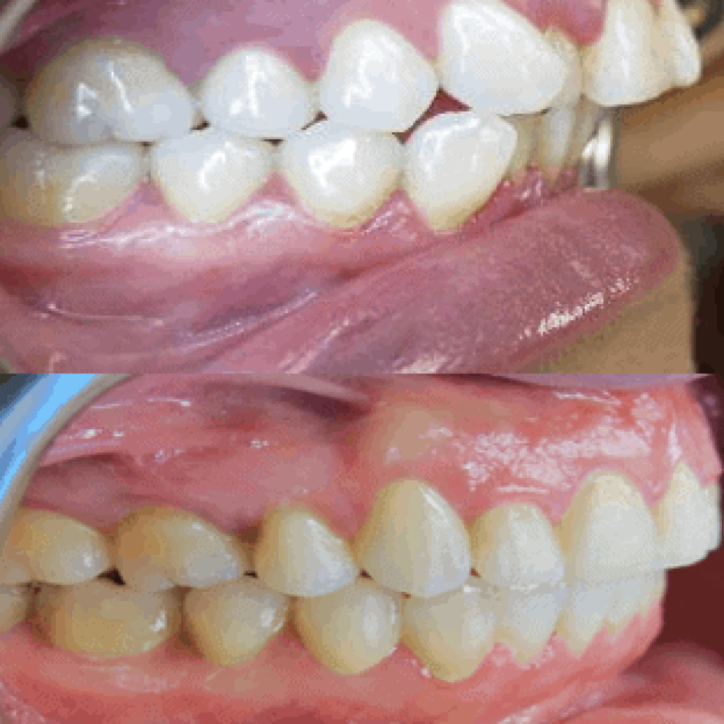 Before & After Gallery Nevada Dentistry & Braces Las Vegas