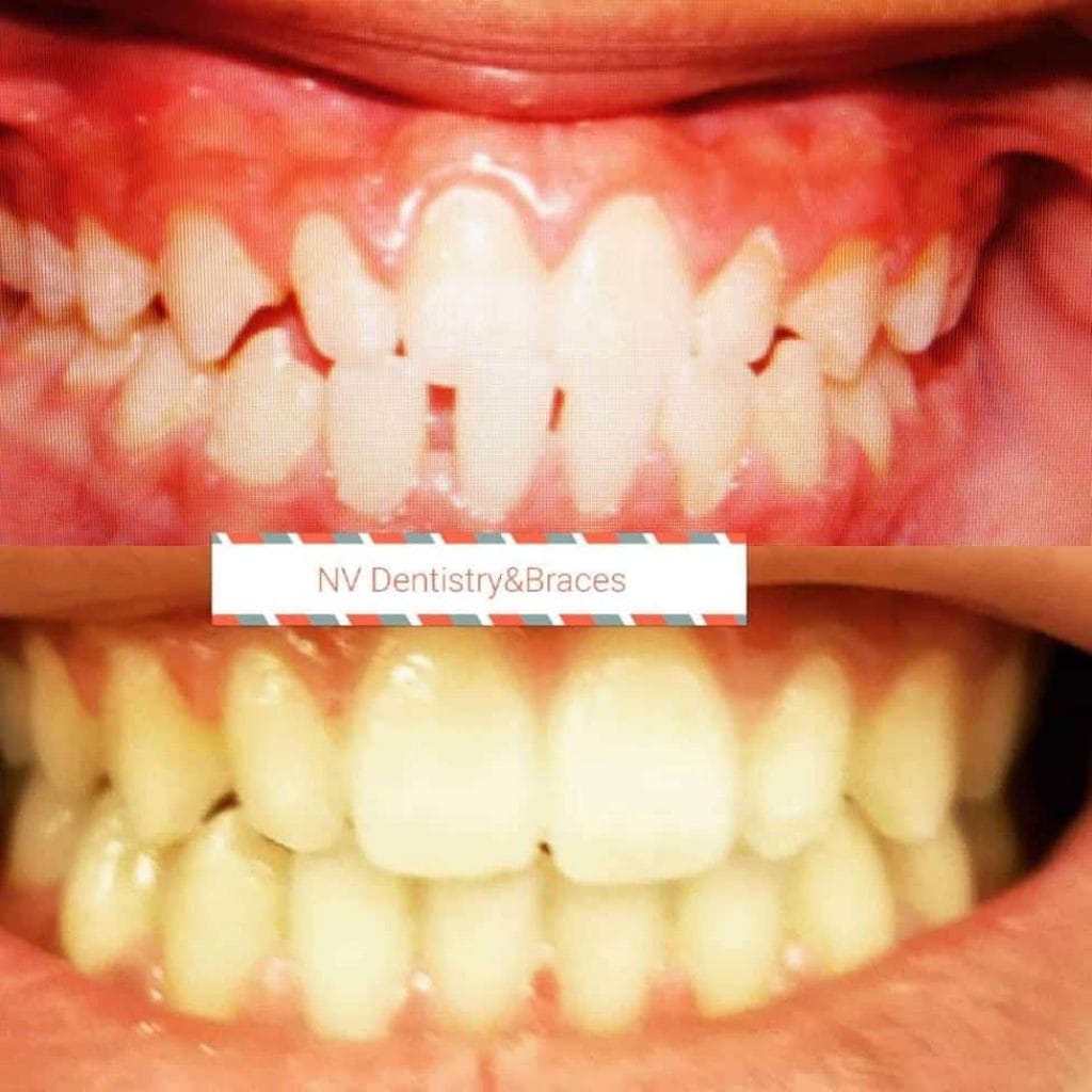 Before & After Gallery Nevada Dentistry & Braces Las Vegas