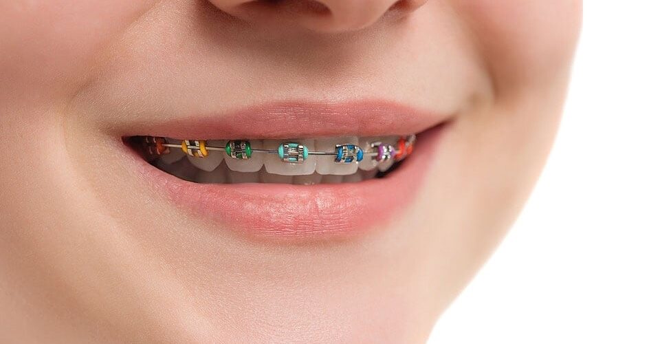 A Guide To Fun Colored Braces - Nevada Dentistry & Braces