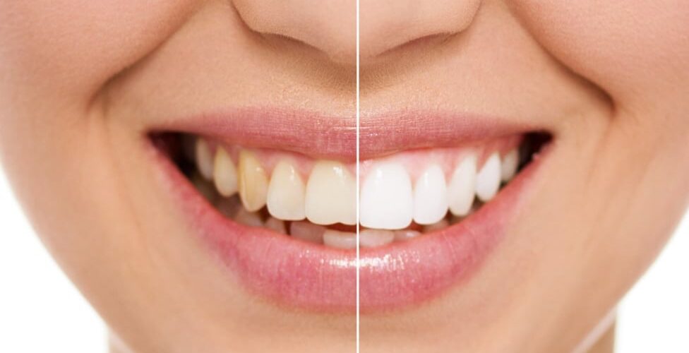 Cosmetic Dentist White Teeth