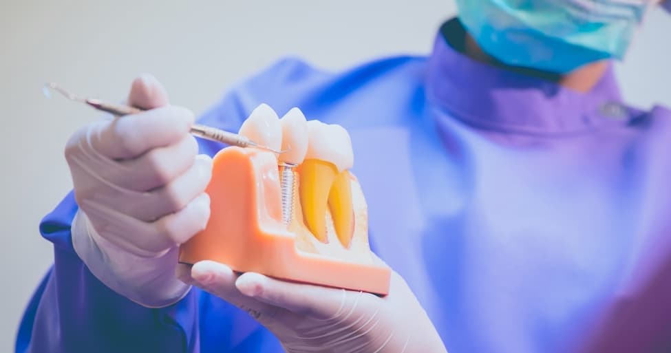 Dental Implants Vs Bridges