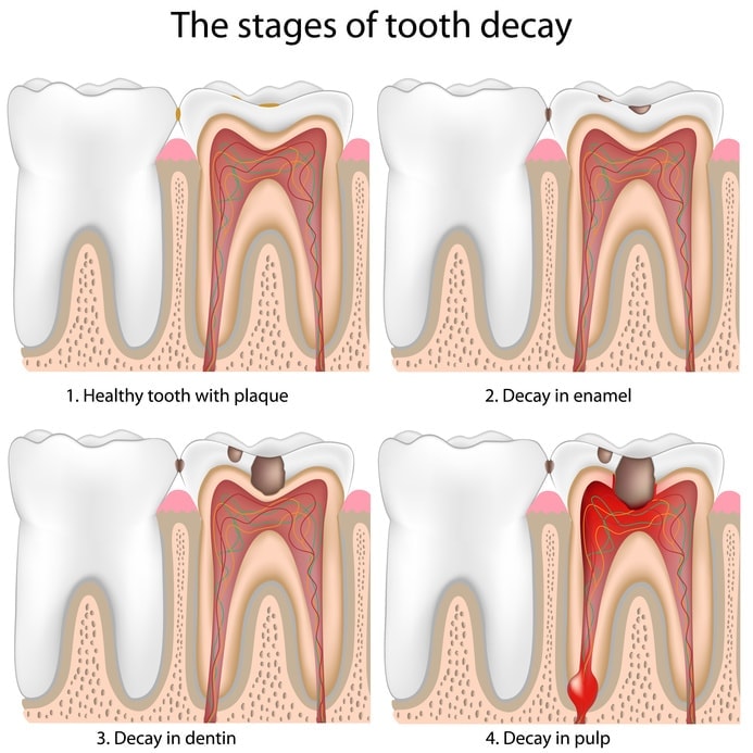 Causes & Treatments For Bleeding Gums Nevada Dentistry & Braces