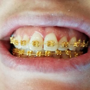 Gold Braces Orthodontist LV