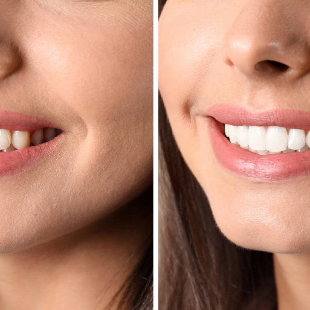 The Safest Way To Whiten Your Teeth Las Vegas Nevada Dentistry & Braces