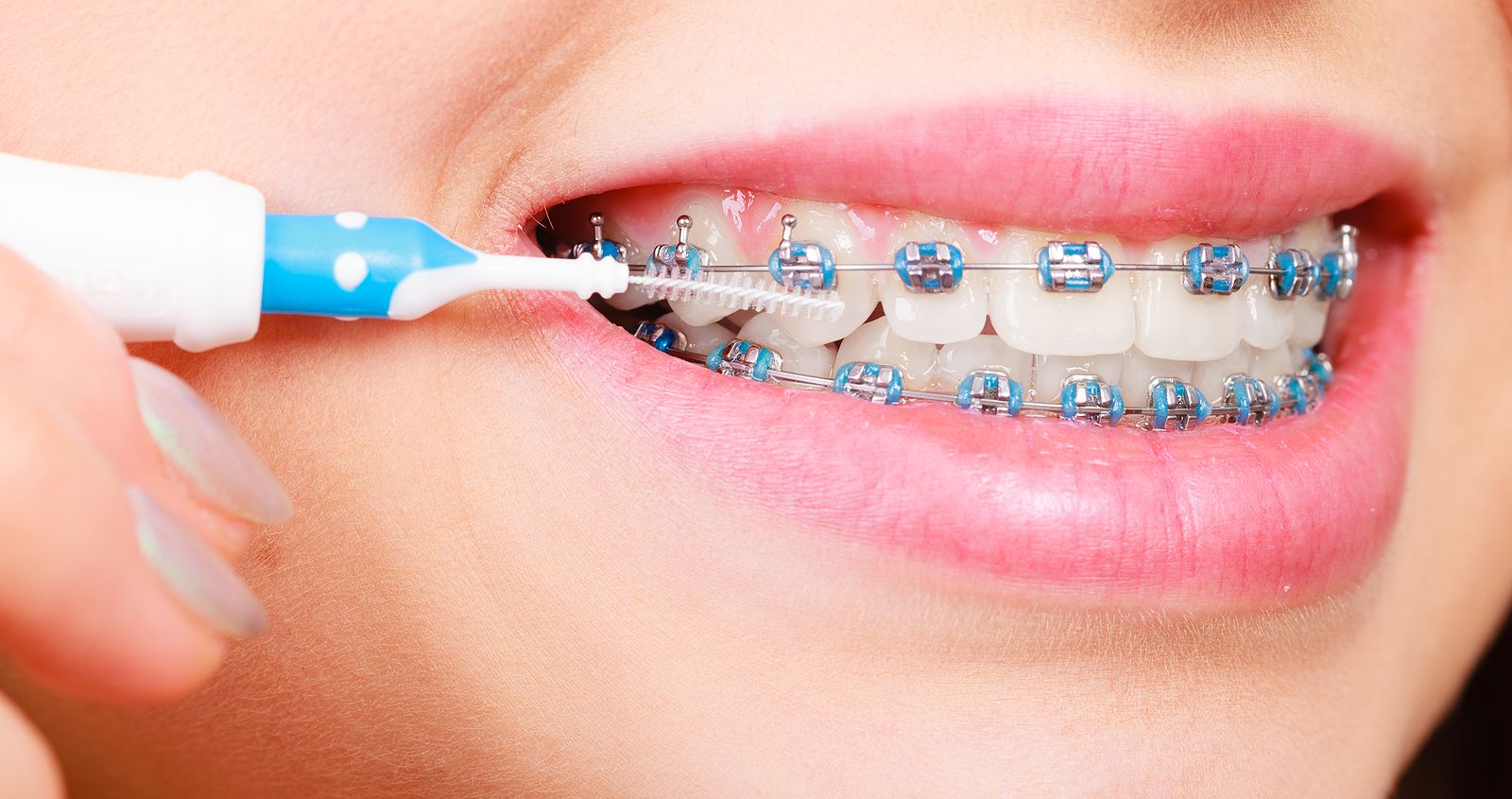 4 Tips For Brushing & Flossing With Braces