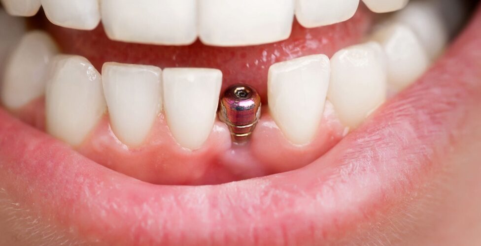 A person showing off their dental implant, that is waiting for a crown.