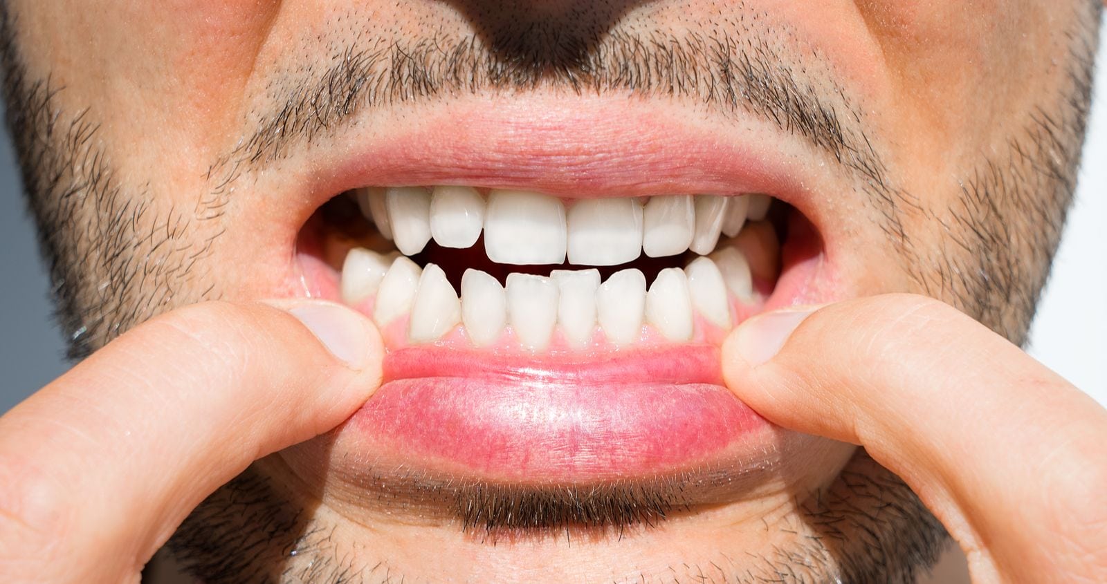 what-causes-crooked-teeth
