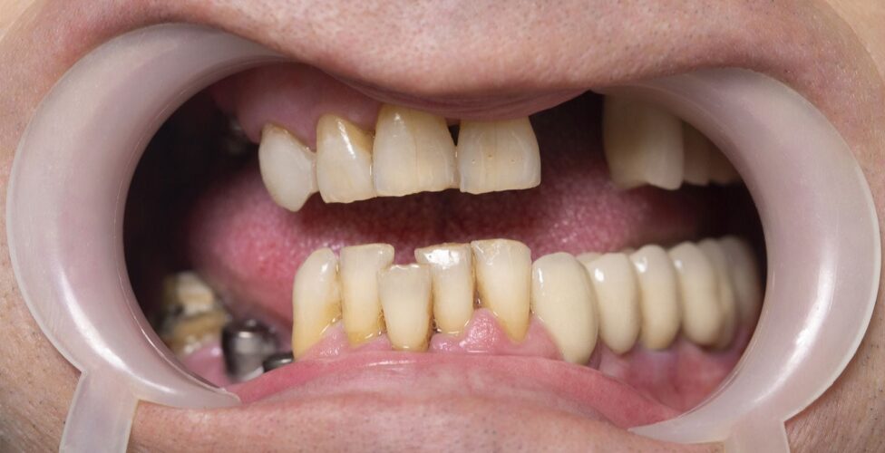 Person's mouth with crooked, misaligned teeth