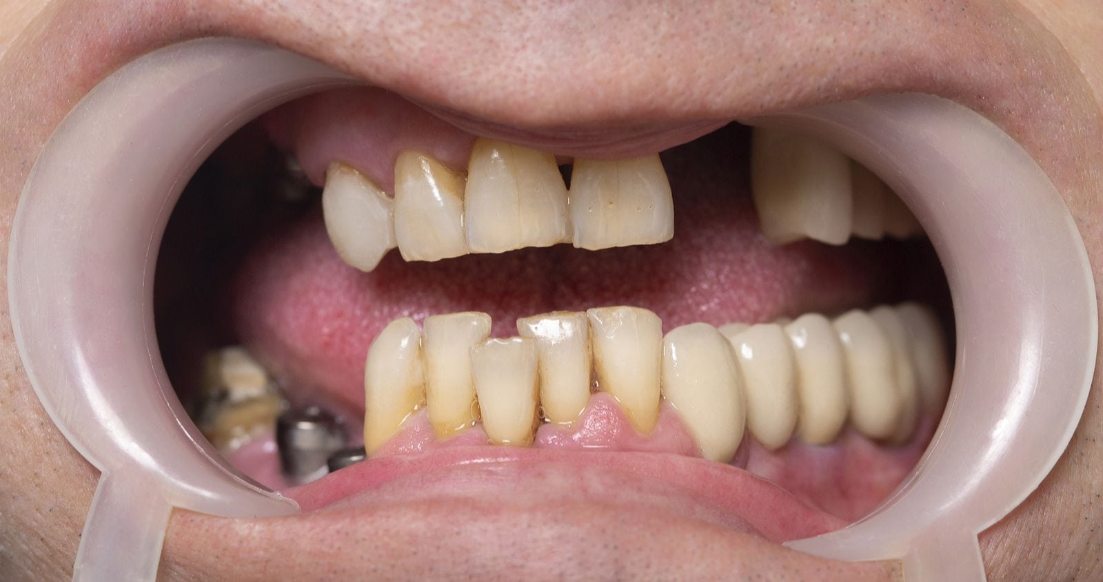 Person's mouth with crooked, misaligned teeth